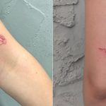 De beste Tatovering en Rotnes